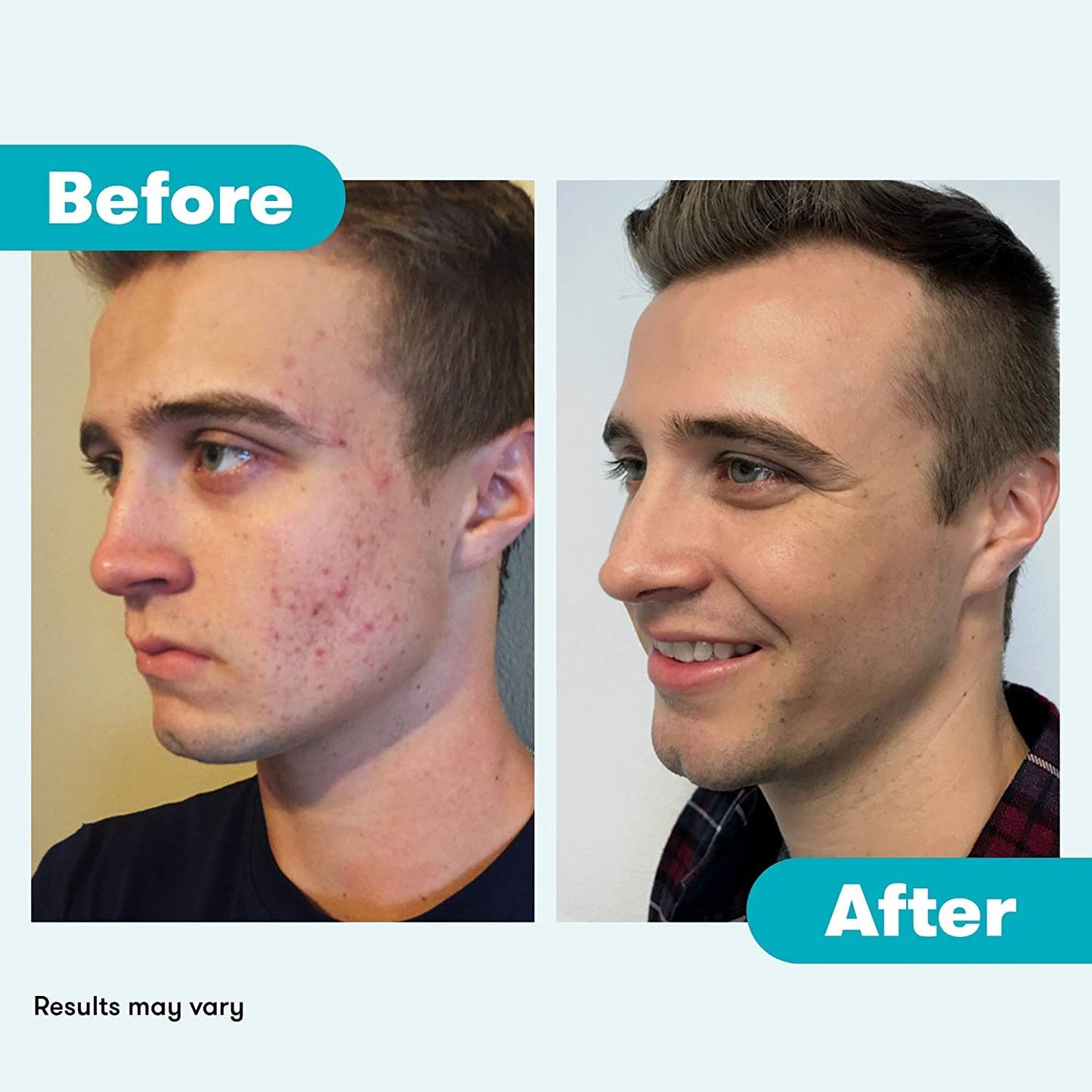 Proactiv Acne Cleanser - Benzoyl Peroxide Face Wash and Acne Treatment - Daily Facial Cleanser and Hyularonic Acid