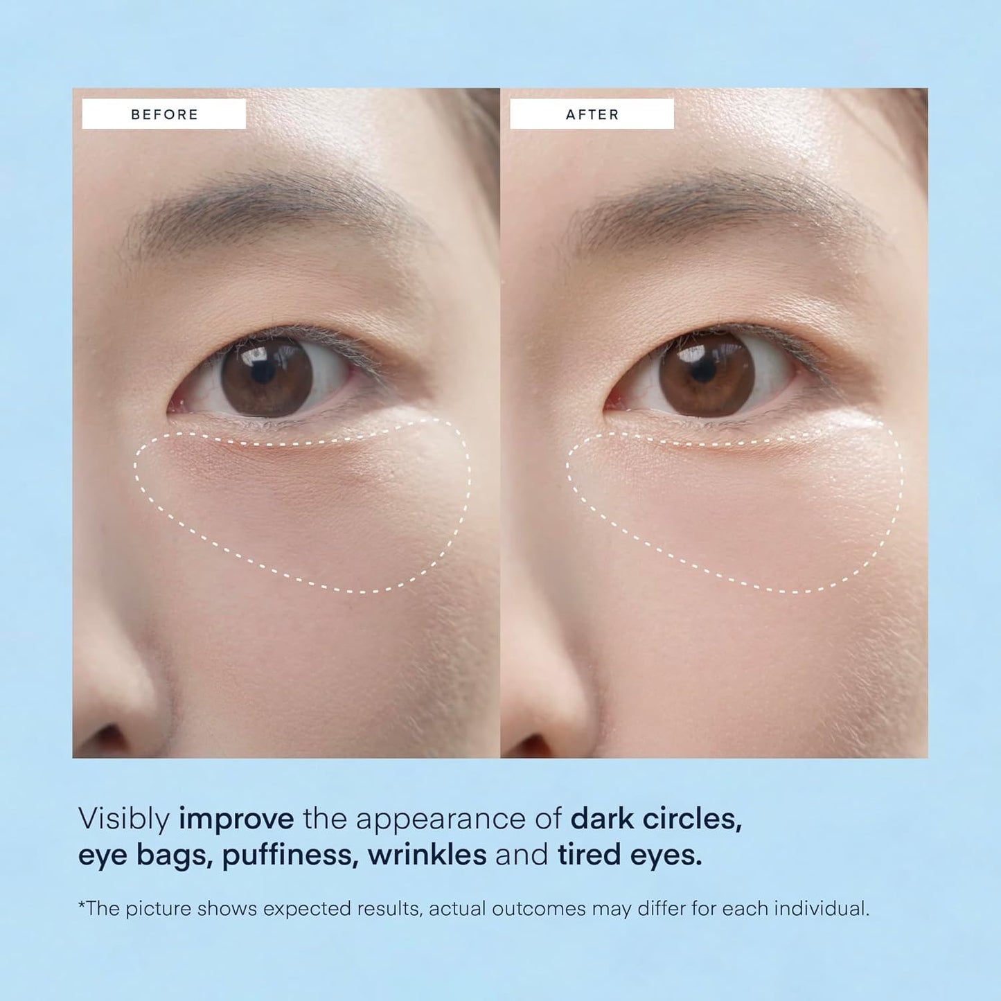 Terez & Honor Under Eye Patches for Dark Circles - 60 Korean Hydrogel Masks for Puffiness