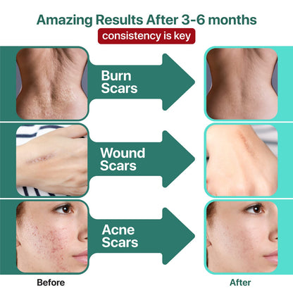 Ebanel Bundle of 30% AHA 2% BHA Chemical Peel and Advanced Silicone Scar Gel