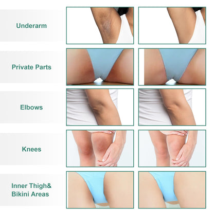 Vcetree Skin Bleaching Cream Skin Lightening for Body Intimate Areas, Private Parts, Underarm, Knees, Elbows, Inner Thigh, Bikini Area