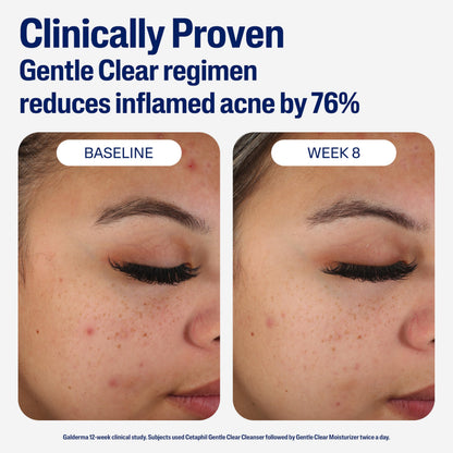 Cetaphil Face Moisturizer, Gentle Clear Mattifying Acne Moisturizer With 0.5% Salicylic Acid