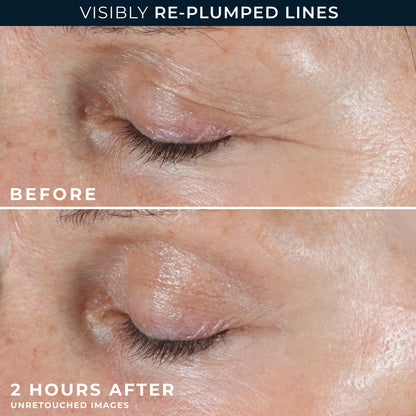 RoC Retinol Correxion Deep Wrinkle Non-Invasive Targeted Patches with Hyaluronic Acid + Firming Peptides for Forehead, 11 Lines