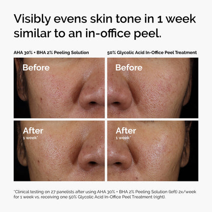 The Ordinary AHA 30% + BHA 2% Peeling Solution, Advanced Exfoliating Peel for Brighter Skin, 1 Fl Oz